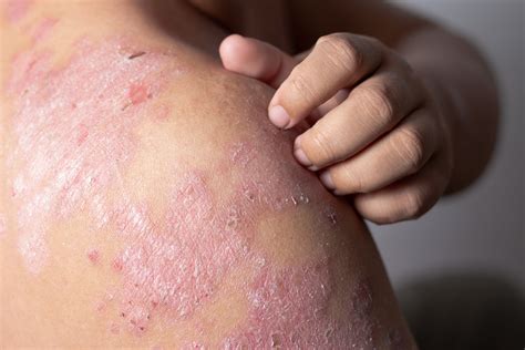 Guest Article Eczema And Atopic Dermatitis Basics