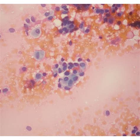 Malignant Cytology Colloid Poor Papillary Structures Bc 6 Lbc He