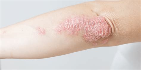 A Dermatologist Shares What You Need To Know About Psoriasis Even If You Dont Have It The