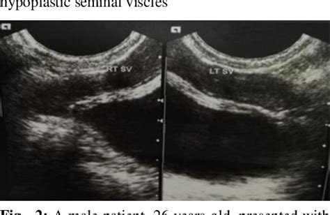 Figure 1 From Role Of Trans Rectal Ultrasonography For Evaluation Of