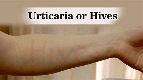 Get Rid Of Urticaria Or Hives Youtube
