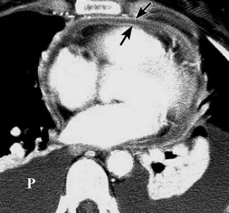 Jun 11, 2019 · dans ces cas, le scanner thoracique ou l'irm peuvent être utiles ; CT and MR Imaging of Pericardial Disease | RadioGraphics