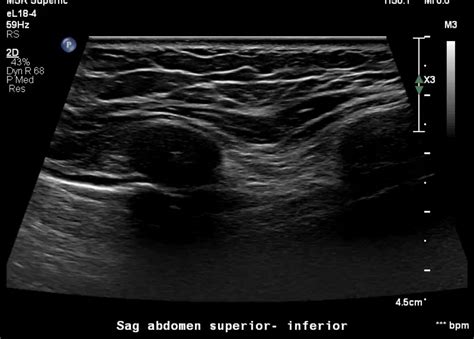 Do You Want To Know How To Scan The Ribs Using Ultrasound