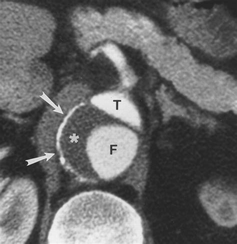 Aortic Dissection Ct Features That Distinguish True Lumen From False