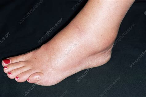 Sprained Ankle Stock Image M3301238 Science Photo Library