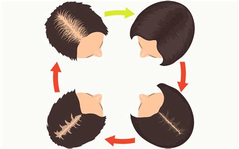 Female Pattern Hair Loss Why It Occurs Who It Affects And How To Deal