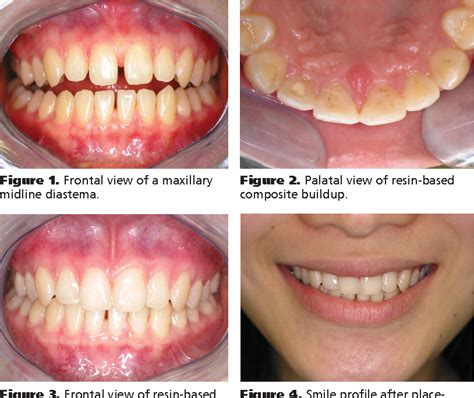 Figure 1 From Treating A Maxillary Midline Diastema In Adult Patients