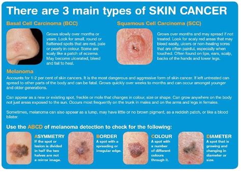Types Of Melanoma Non Melanoma Skin Cancer Nmsc My Board