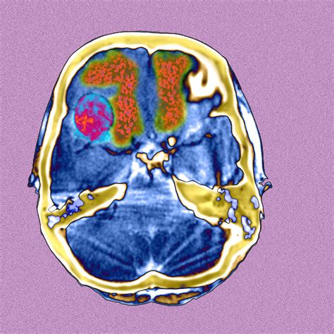 Secondary Brain Cancers Ct Scan Photograph By Du Cane Medical Imaging