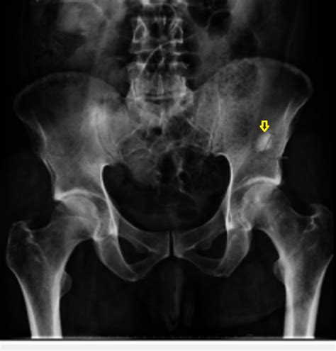 Iliac Bone Anatomy X Ray