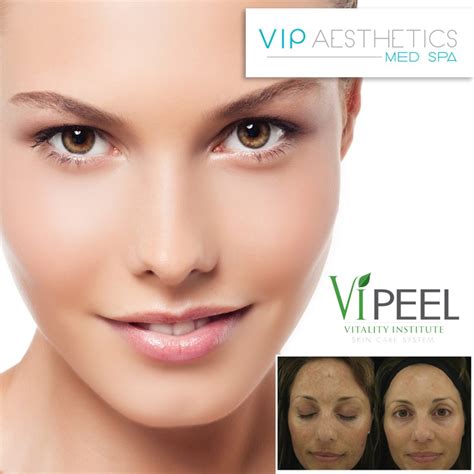Vi Peel A Great Choice For Your Skin Vip Aesthetics Fort