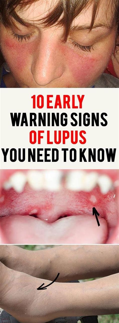 10 Early Warning Signs Of Lupus You Need To Know Naturally Medication