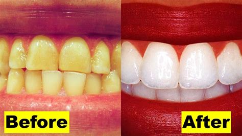 Find out what your best bets are, and which to not bother with. How to Whiten your Yellow Teeth Naturally at Home | Home ...