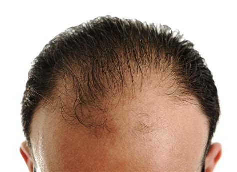 What Is Considered A Normal Hairline With Pictures