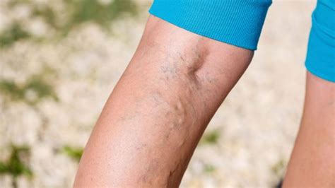 10 Varicose Vein Myths Everyday Health