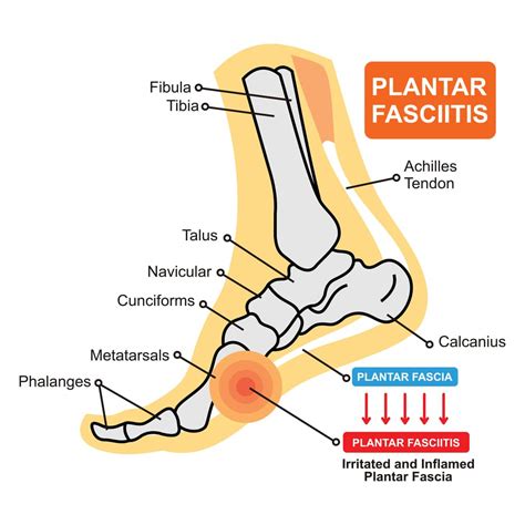 How To Wrap Your Foot For Plantar Fasciitis Recommended Tips And Tricks