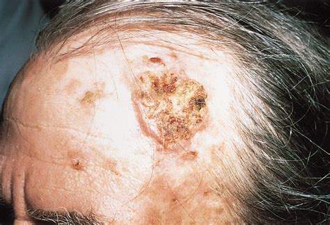 Aggressive Squamous Cell Carcinomas In Persons Infected With The Human