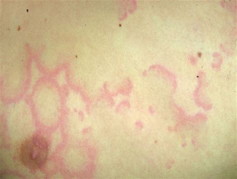 Image Erythema Marginatum Msd Manual Consumer Version