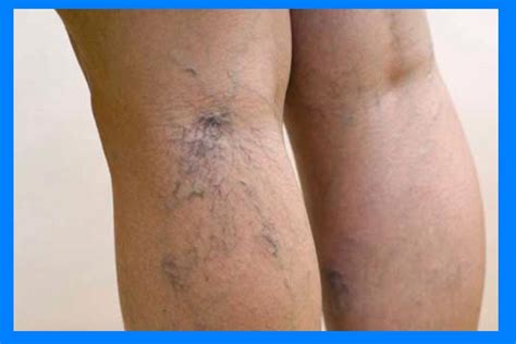 Causes Of Varicose Veins Common Medical Questions
