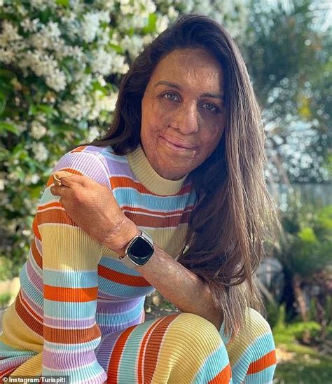 Turia Pitt Says Her Dad Stopped Her From Committing Suicide After She Was Badly Burnt In