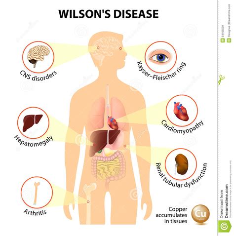Wilson daniels releases 2020 fall luxury offering. Wilson's Disease Stock Photo - Image: 54105539