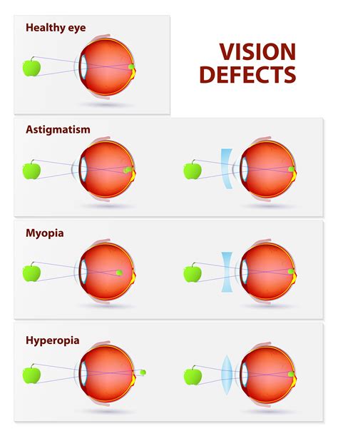 [diagram] diagram of eye with myopia mydiagram online
