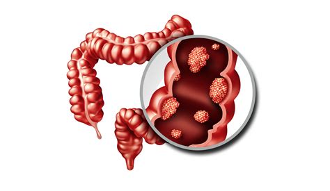 Cáncer de colon en estadio 4 Síntomas Tratamiento y Más SaludAIO