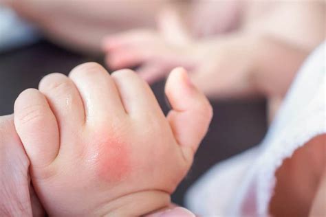 Insect Bites On Babies See How To Treat Them