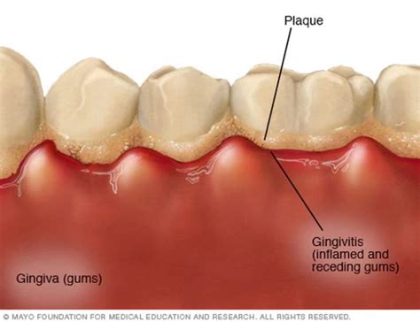 3 Home Remedies To Get Rid Of Gingivitis