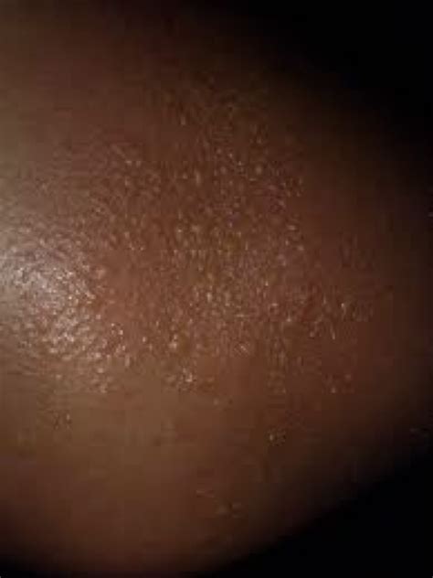 10 Most Common Skin Rashes On Black Skin Blackdoctor