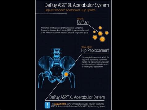 The Depuy Asr™ Defective Hip Implant Recall In Pictures