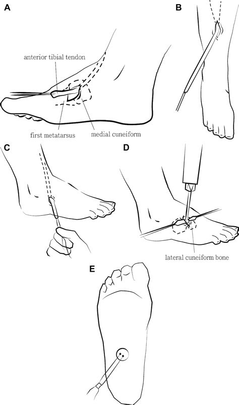 Tendon Transfers Around The Foot Foot And Ankle Clinics