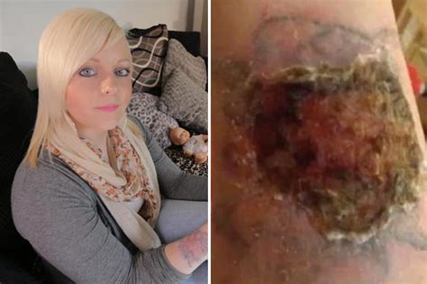Tattoo Removal Kit Burns Hole In Womans Arm Daily Star