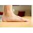 Flat Feet Are More Than Just A Foot Problem  Alliance & Ankle