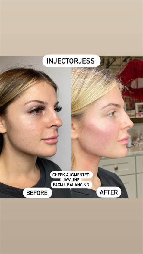 Jawline Filler Lux Injectable