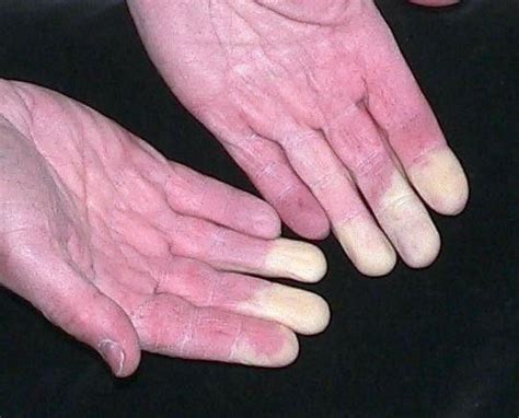 15 Photos That Show What It Looks Like To Live With Raynaud S Syndrome Artofit