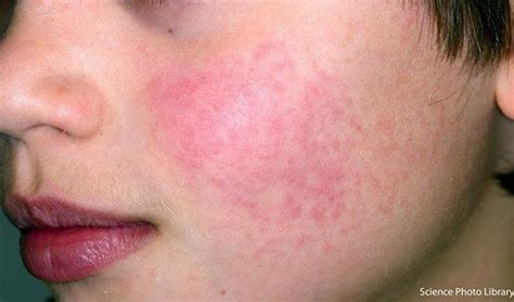 Slapped Cheek Syndrome What The Rash Looks Like Madeformums