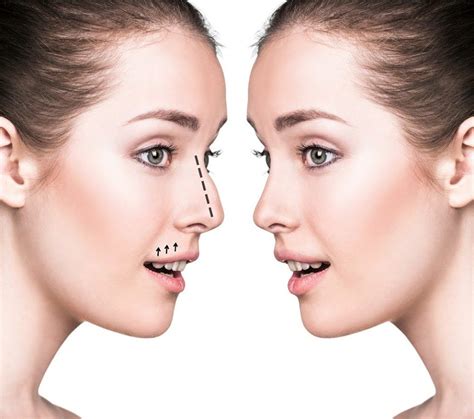 What Is The Difference Between Rhinoplasty And Septoplasty By Samuel