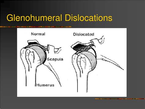 Ppt Dislocation And Fracture Reductions Powerpoint Presentation Free
