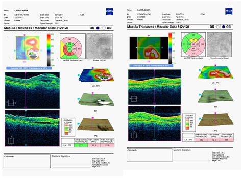 new insights into the optical coherence tomography assessement and follow up of age related