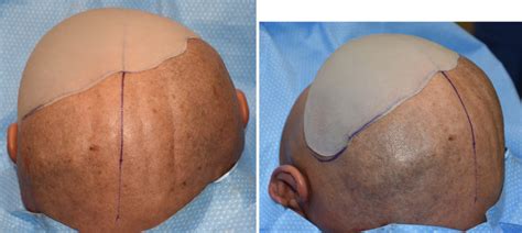 Plastic Surgery Case Study Custom Occipital Skull Implant For