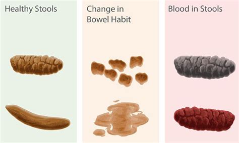 What Does Blood In Stool Look Like Colon Cancer What Does