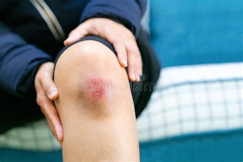 Knee Scratch Stock Photo Image Of Little Medical Girl 17089686