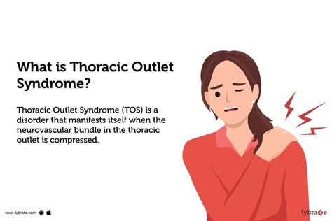 Thoracic Outlet Syndrome Causes Symptoms Treatment And Cost