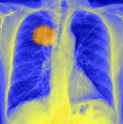 Lung Cancer X Ray Stock Image C0212967 Science Photo Library