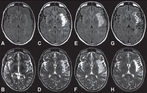 Magnetic Resonance Imaging In Hemorrhagic And Ischemic Stroke Neupsy Key