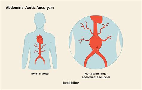 What Causes Aortic Aneurysms Milner Vein And Vascular
