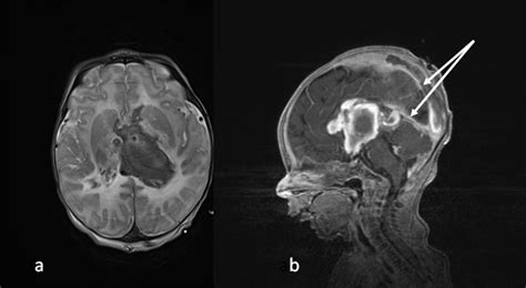 Perinatal Stroke Syndromes Similarities And Diversities In Aetiology