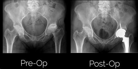 Anterior Total Hip Replacement Sumit Rana MD