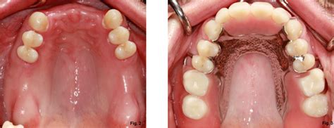 Removable Partial Denture For Maxillary Incisors Spear Education